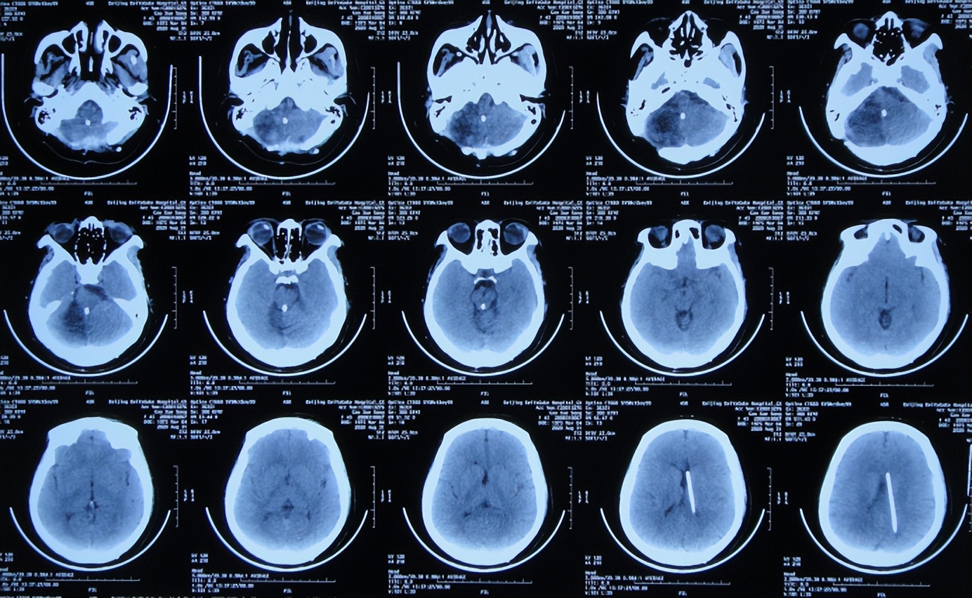 听神经瘤出现脑积水和出血,听神经瘤手术后颅压高症状