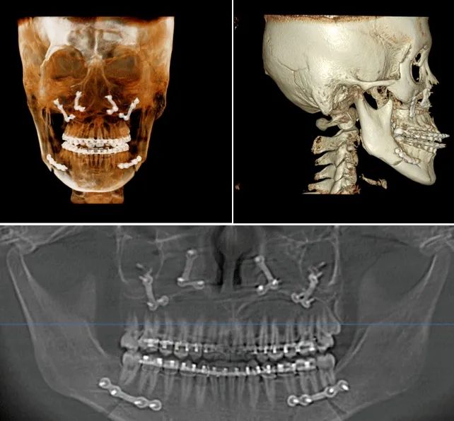 高难度口腔颌面外科手术,口腔颌面外科常见手术