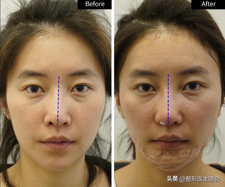 硅胶隆鼻恢复过程经历真实,我做了假体隆胸现在非常后悔