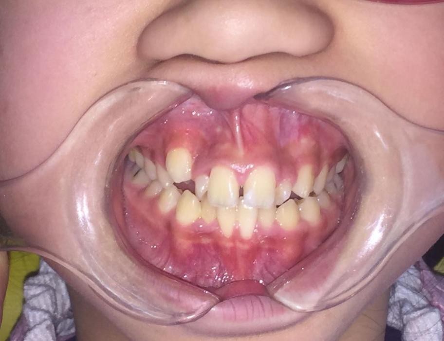 徐州儿童牙齿矫正牙齿不齐,大连口腔医院儿童牙齿矫正怎么样