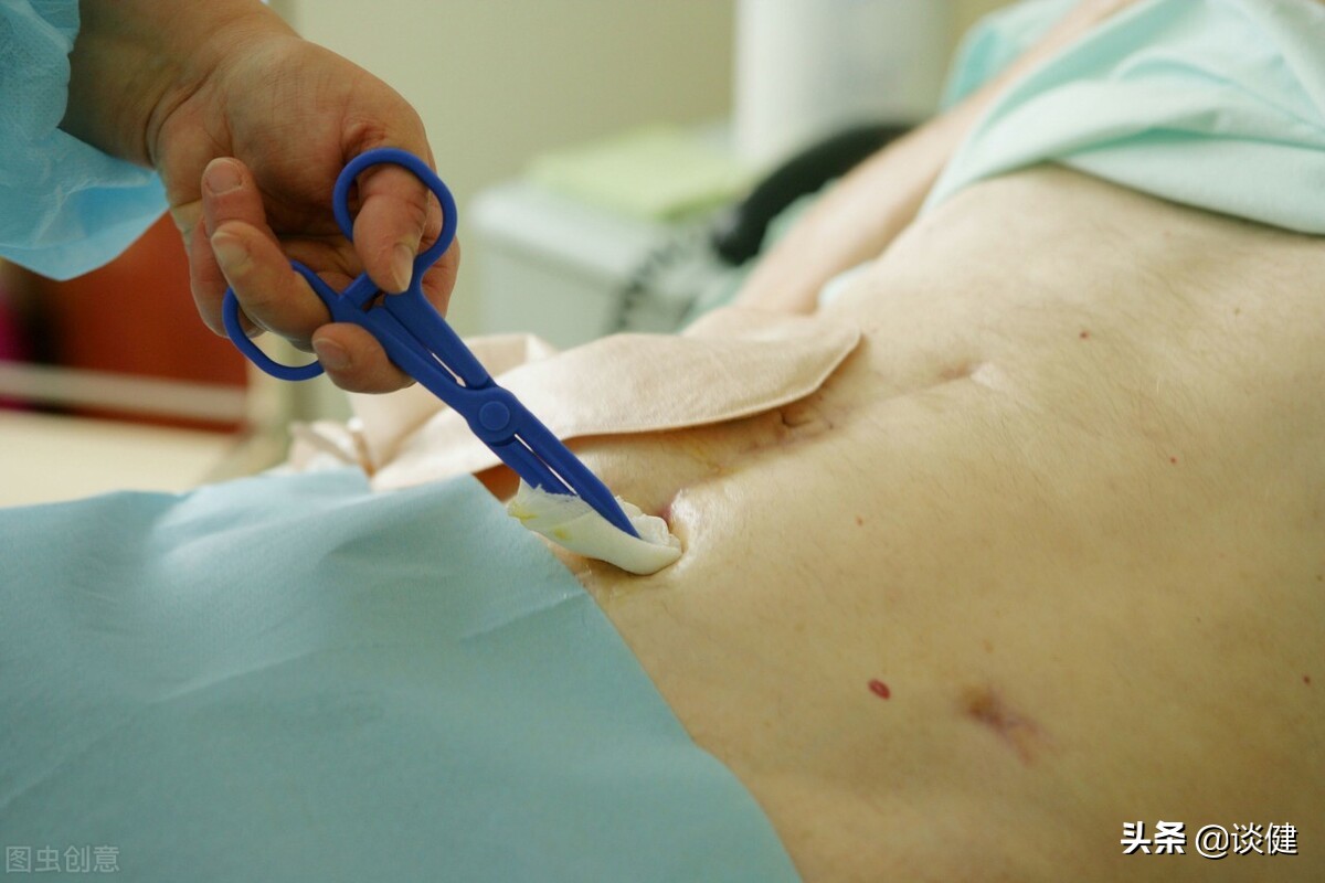 大肠癌的最佳防治方法,大肠癌手术难度大吗