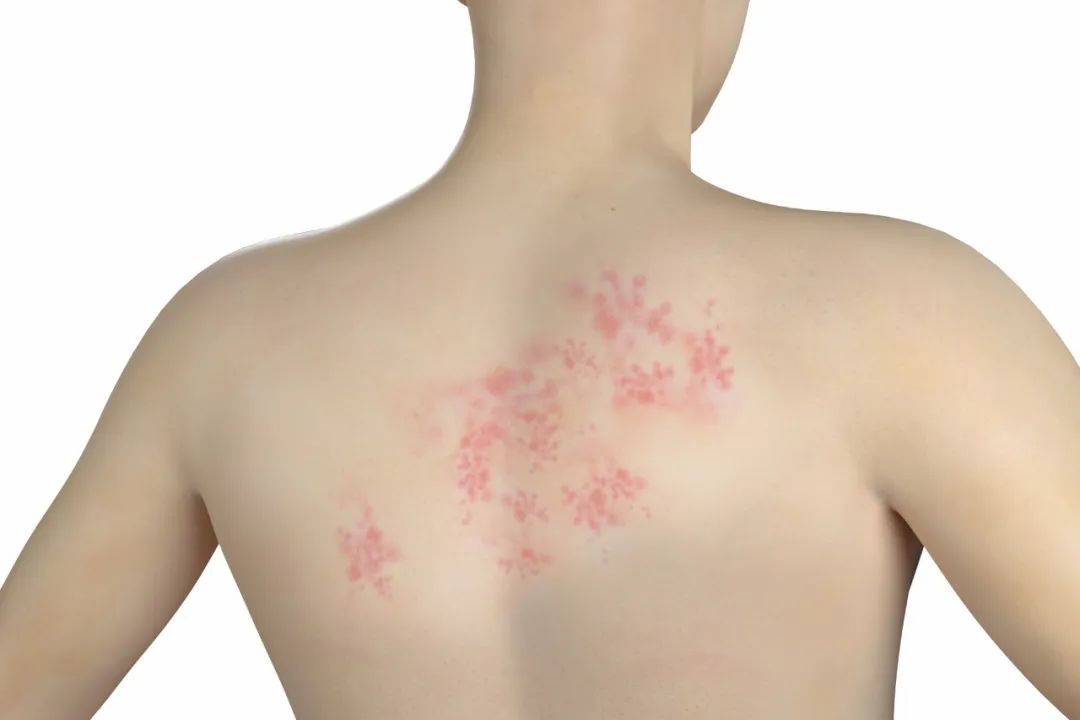 湿疹反复发作怎样做才能好得快,他克莫司软膏治疗湿疹反复发作