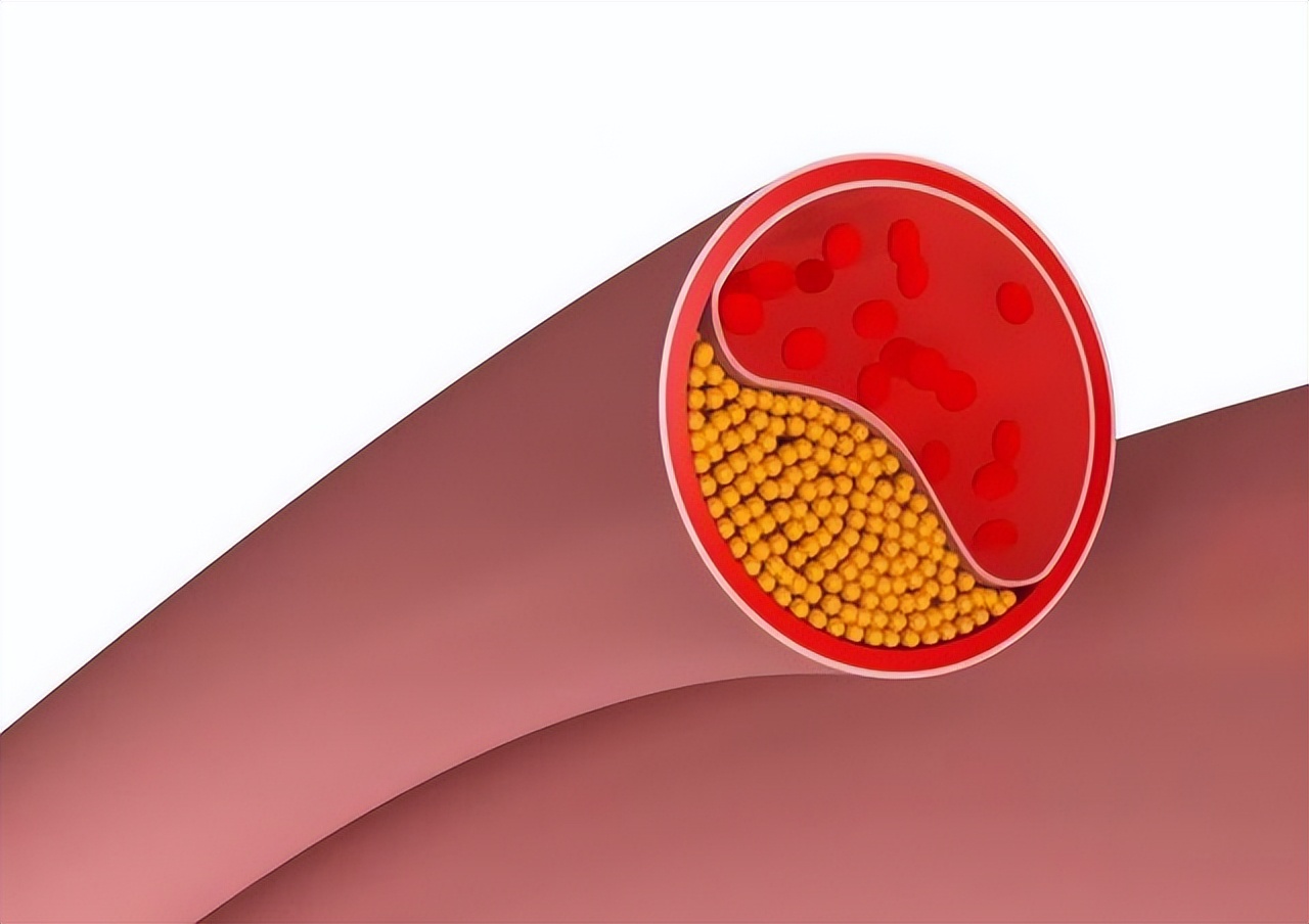 体检颈动脉有斑块但血流未见异常,体检有颈动脉斑块怎么治疗啊