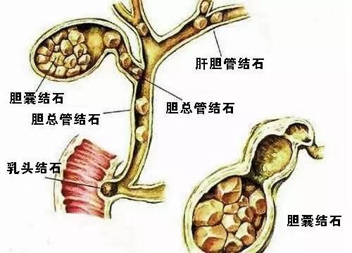 胆结石患者右腹疼痛、食欲差、肤黄尿黄,中医巧用方剂,清热利湿