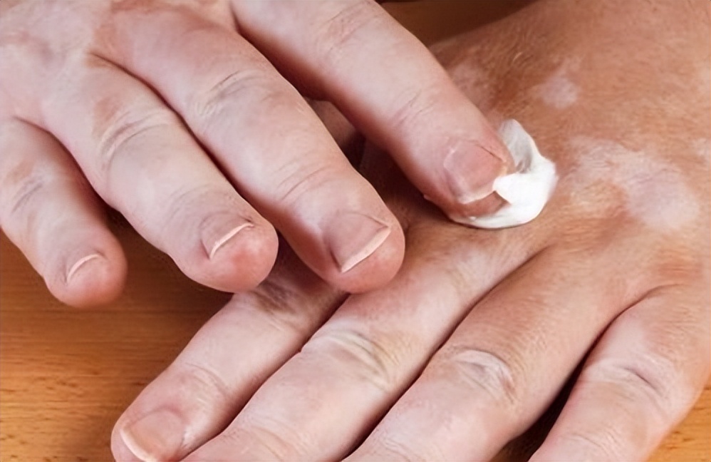 脚气真菌怎么彻底消灭,真菌脚气如何治才可根除