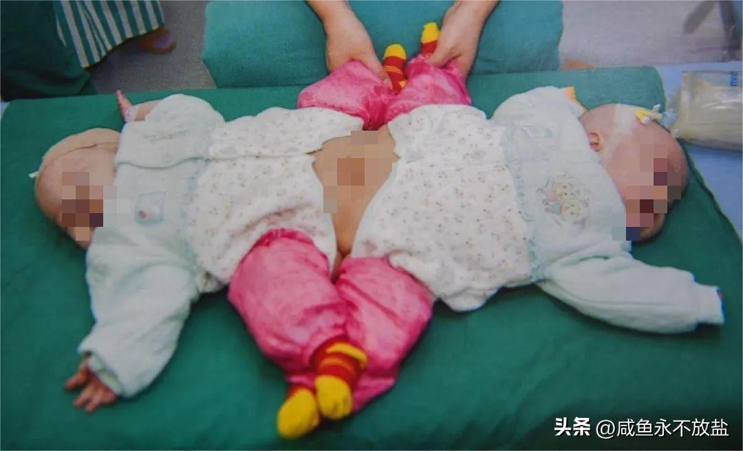 女子生下连体双胞胎后续,女子产下同母异父双胞胎完整版