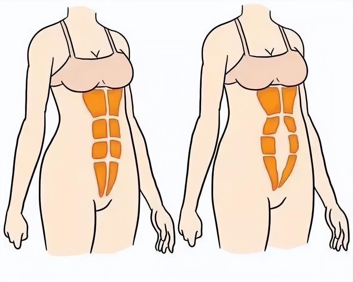 辣妈产后腹直肌分离,母婴店产后恢复腹直肌分离