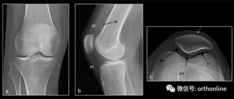 髌骨软化症的最佳疗法是什么,髌骨软化症治疗方法以及康复训练