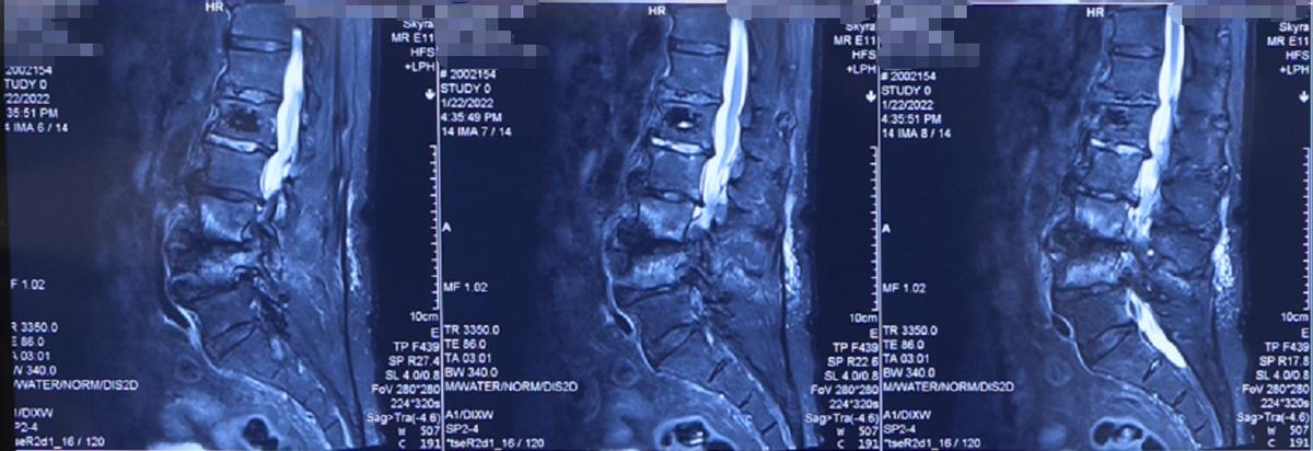 脊柱侧弯腰椎变性,70岁老人腰椎侧弯严重
