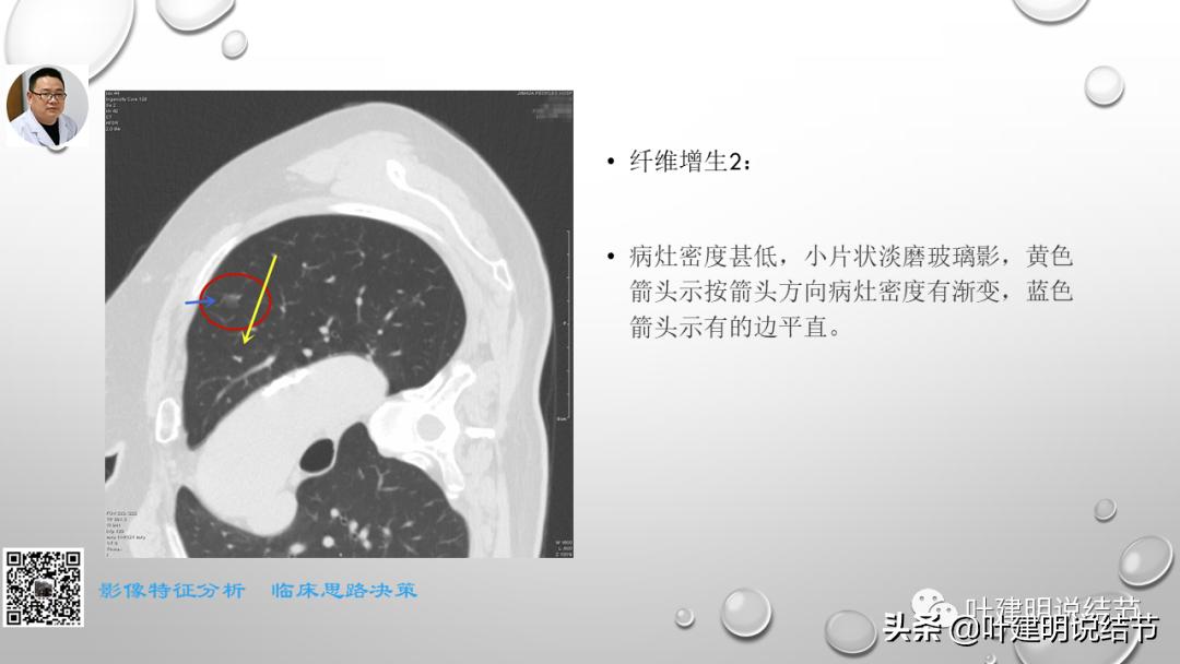 在《一脉阳光》呼吸影像诊断专题培训班上的讲课PPT（第一部分）