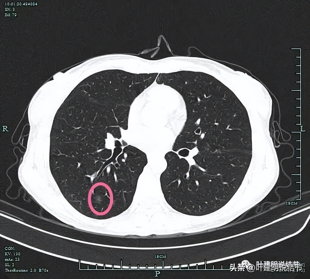 右下叶磨玻璃结节5*4,右下叶磨玻璃样结节多为炎性