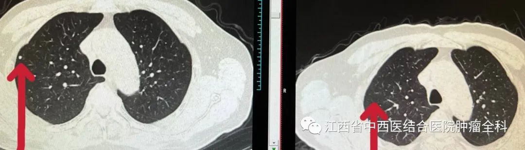 肝癌多发性肝内转移靶向药,肝癌中晚期免疫靶向有奇迹出现吗