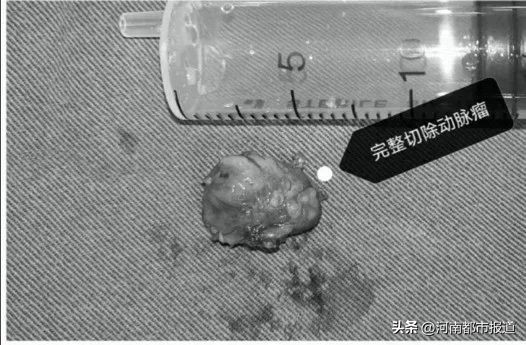 宝宝坠床摔出“动脉瘤”，回老家河南千里寻医