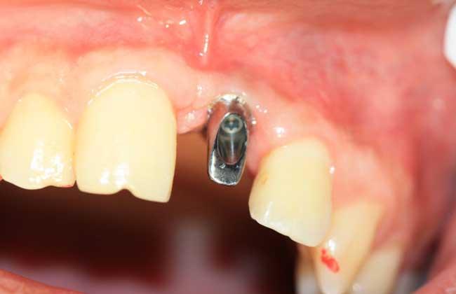 种牙医生说种牙过程,种植牙技术有几种方法