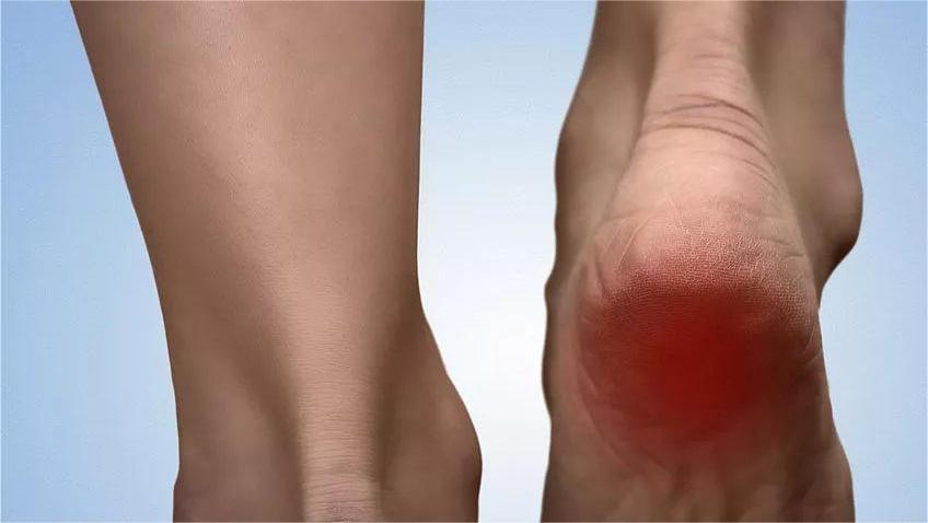 脚后跟痛警惕三种病,脚后跟痛要警惕什么