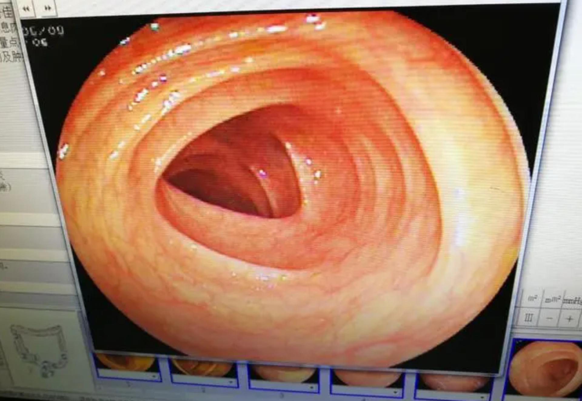 结肠长息肉是什么原因造成的,结肠息肉切除肚子还疼是什么原因