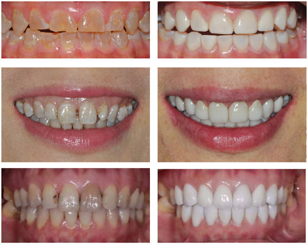 戴烤瓷牙的好处和坏处,烤瓷牙有几种它们的优缺点