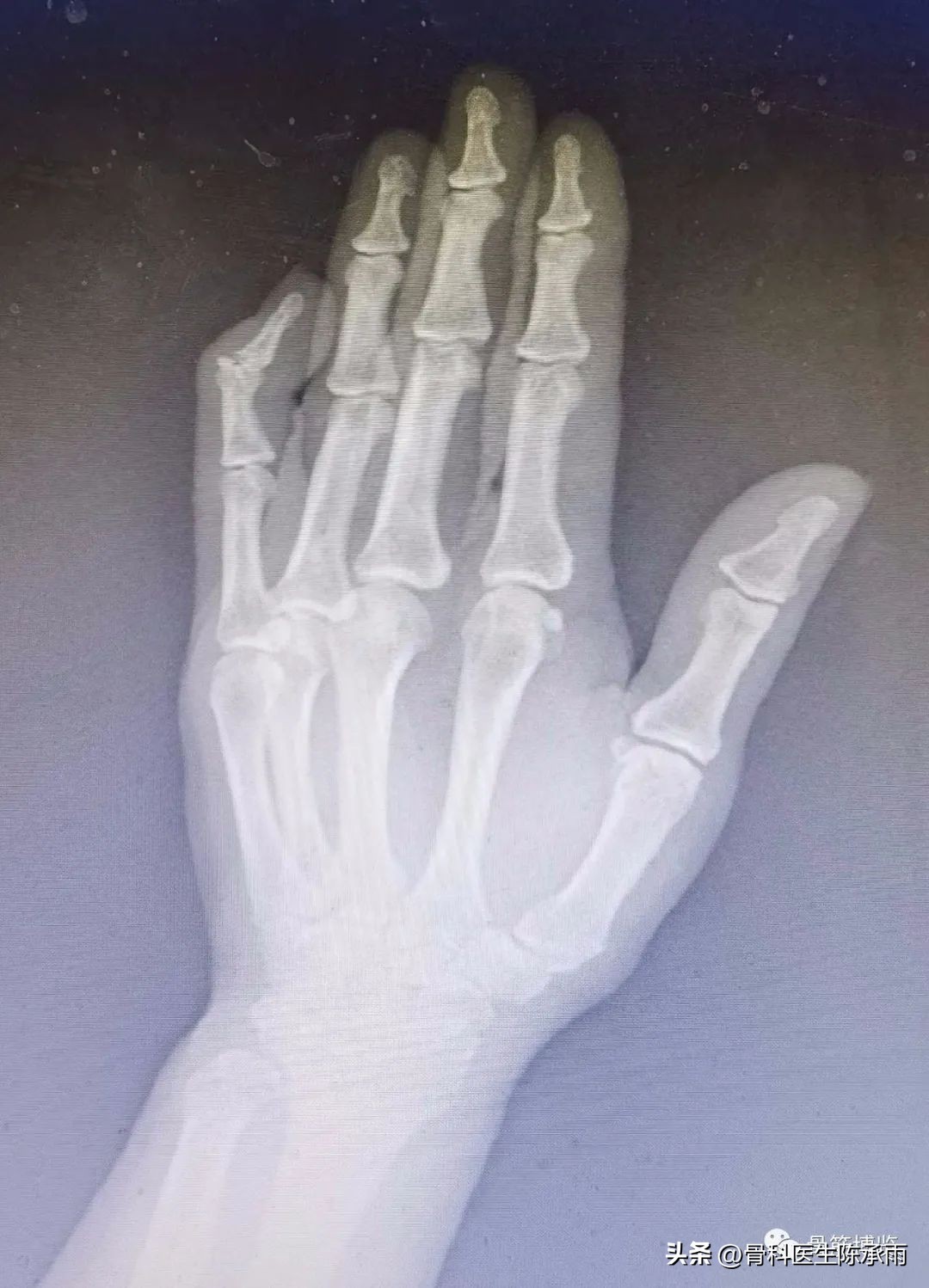 手指出现锤状畸形不要太紧张，看后知道伸肌腱止点断裂重建术