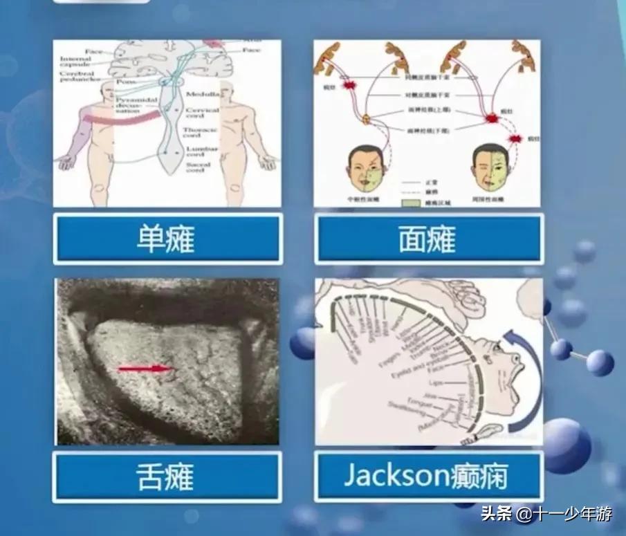 大脑的结构解剖示意图,大脑镰下疝解剖结构