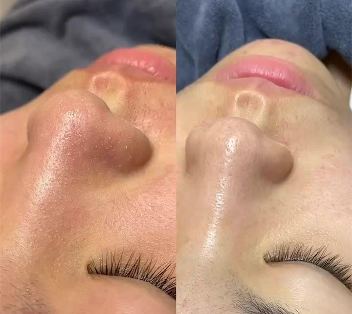 去除鼻子黑头收缩毛孔小妙招,鼻子黑头毛孔大抹什么药膏