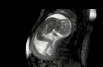 孕晚期胎宝宝一抖一抖,胎宝宝在肚子里一抖一抖是打嗝吗