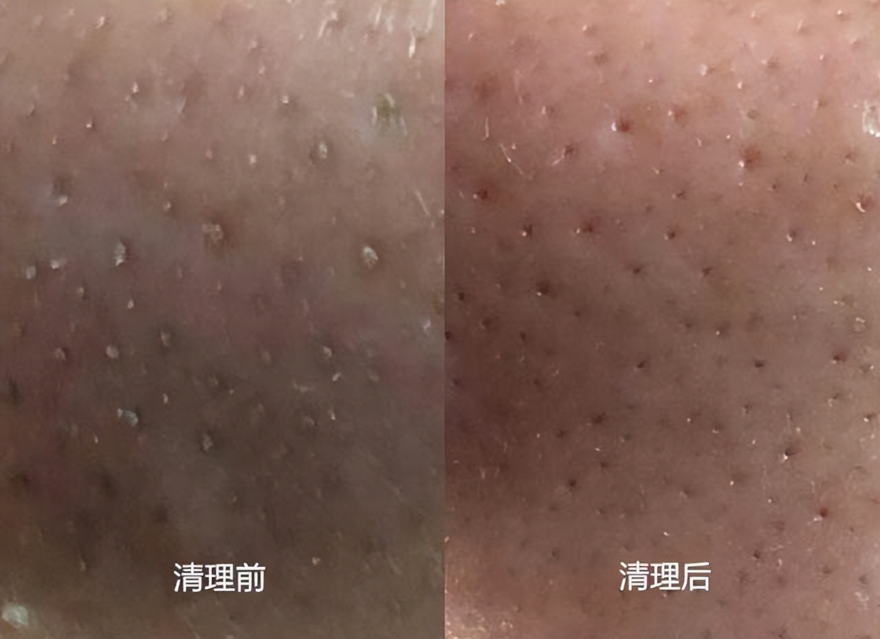 额头眉心发红有闭口粉刺,眉心鼻头频繁起粉刺怎么办