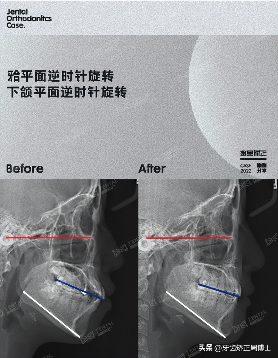 低角面型下巴前倾正畸案例,露龈笑嘴凸下巴后缩