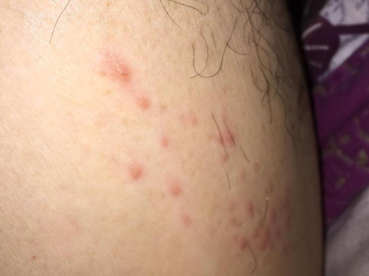 腋窝有个疙瘩是不是艾滋病,腋窝下有疙瘩是艾滋病吗