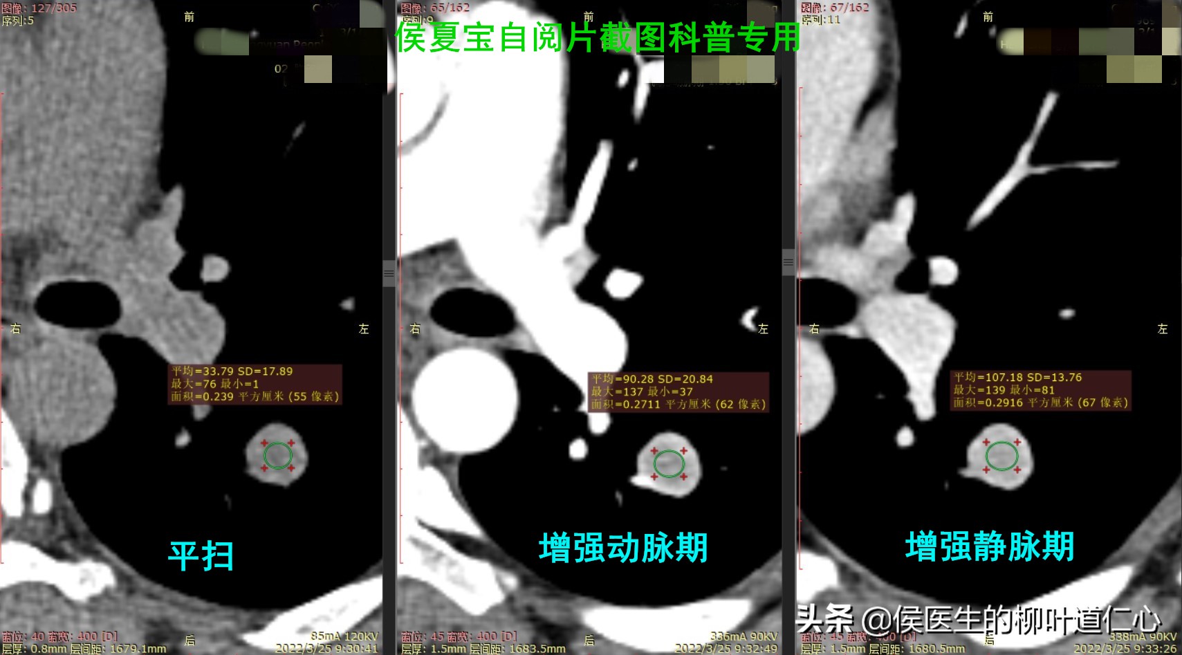 这例“被肺癌”的结节，手术不过度，但完全可以延迟在疫情后