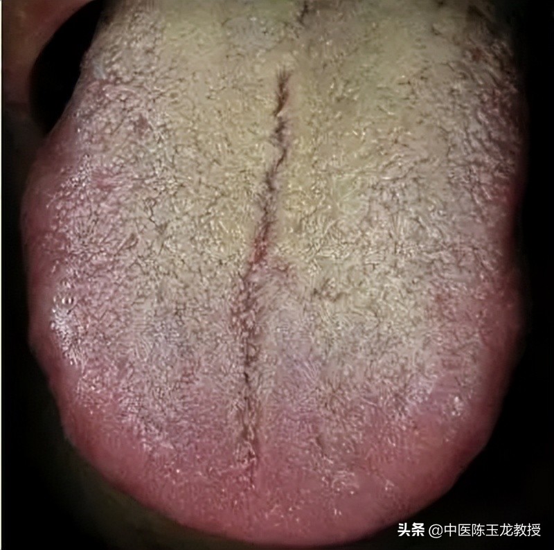 湿热最怕的草药,脾胃湿热和肝胆湿热同治的中成药