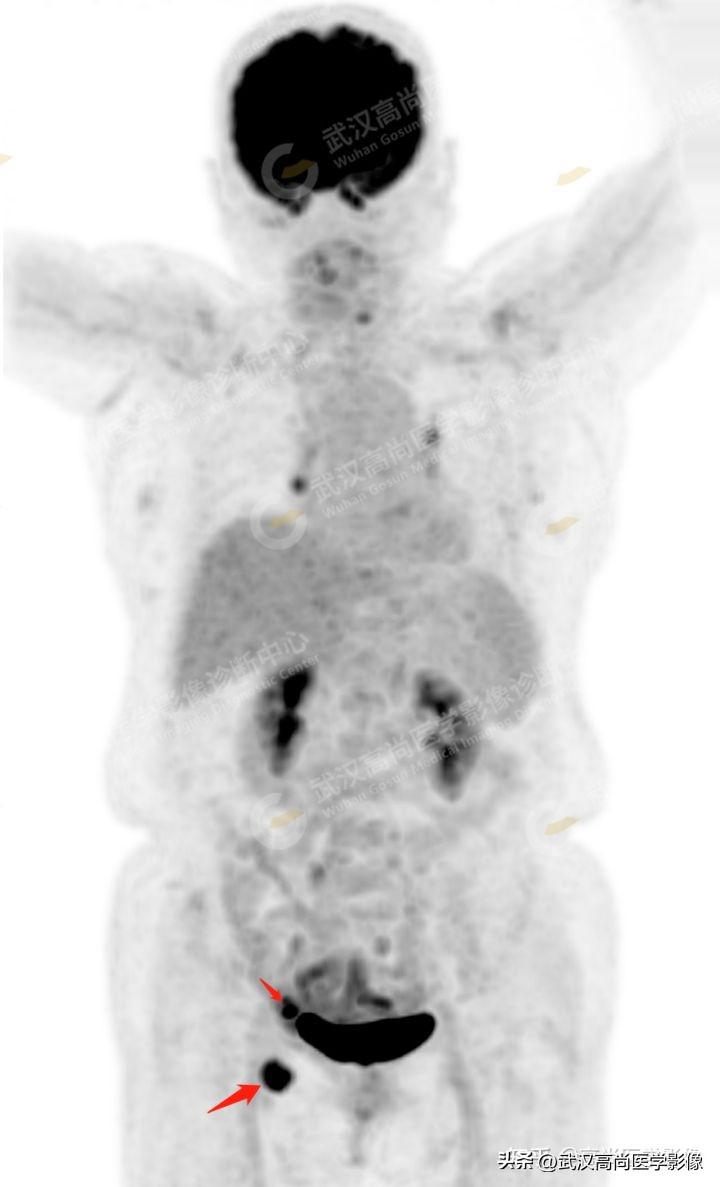 罕见卵巢恶性肿瘤,肿瘤罕见病