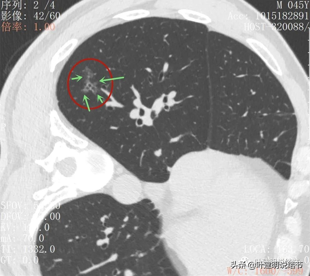 误诊肺纤维化,肺蜂窝状是癌吗