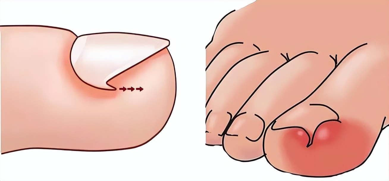 一走路脚趾甲里疼怎么回事,甲沟炎拔完脚趾甲很疼怎么办