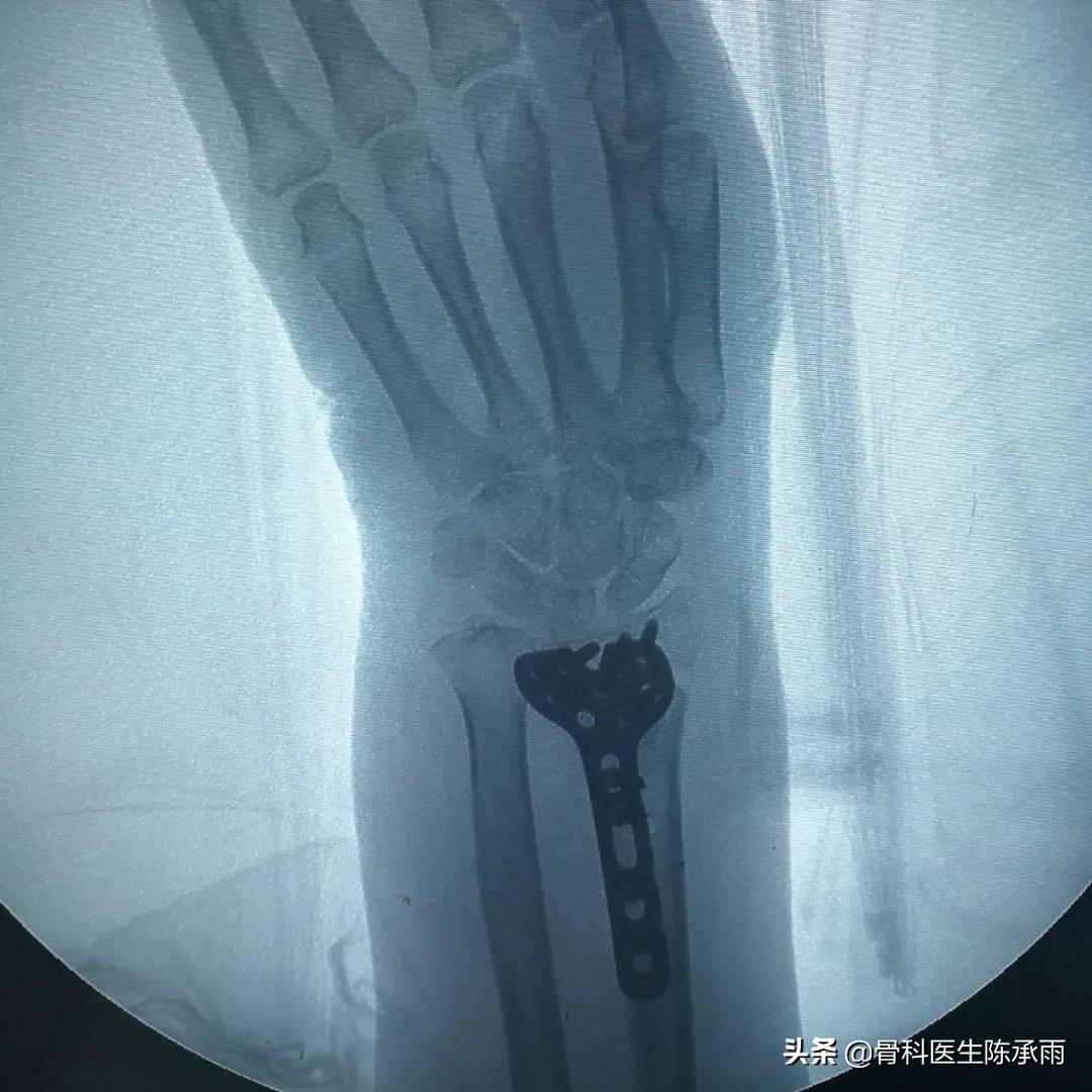 桡骨远端骨折累及关节面保守治疗,桡骨骨折保守还是手术