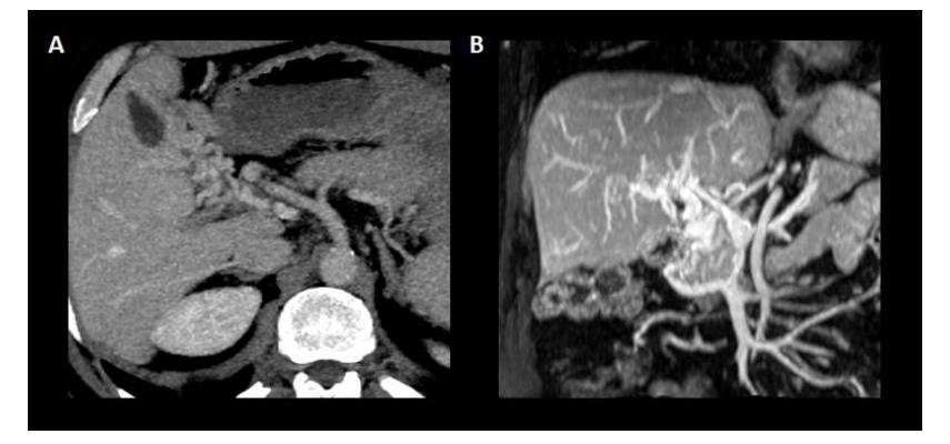 肝硬化门静脉高压伴血栓处理办法,介入后出现下腔静脉血栓