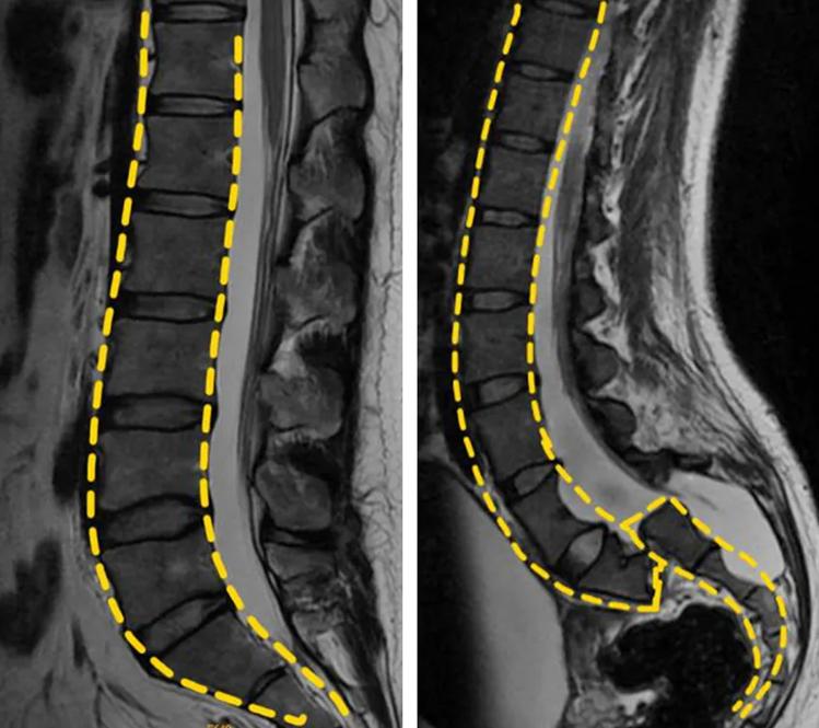 腰椎滑脱手术内固定失败症状,腰椎滑脱前移和后移症状一样吗