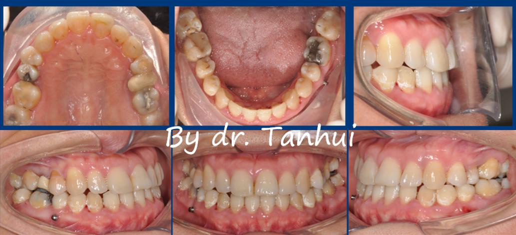 地包天能做手术矫正吗,儿童地包天矫正几岁做最好