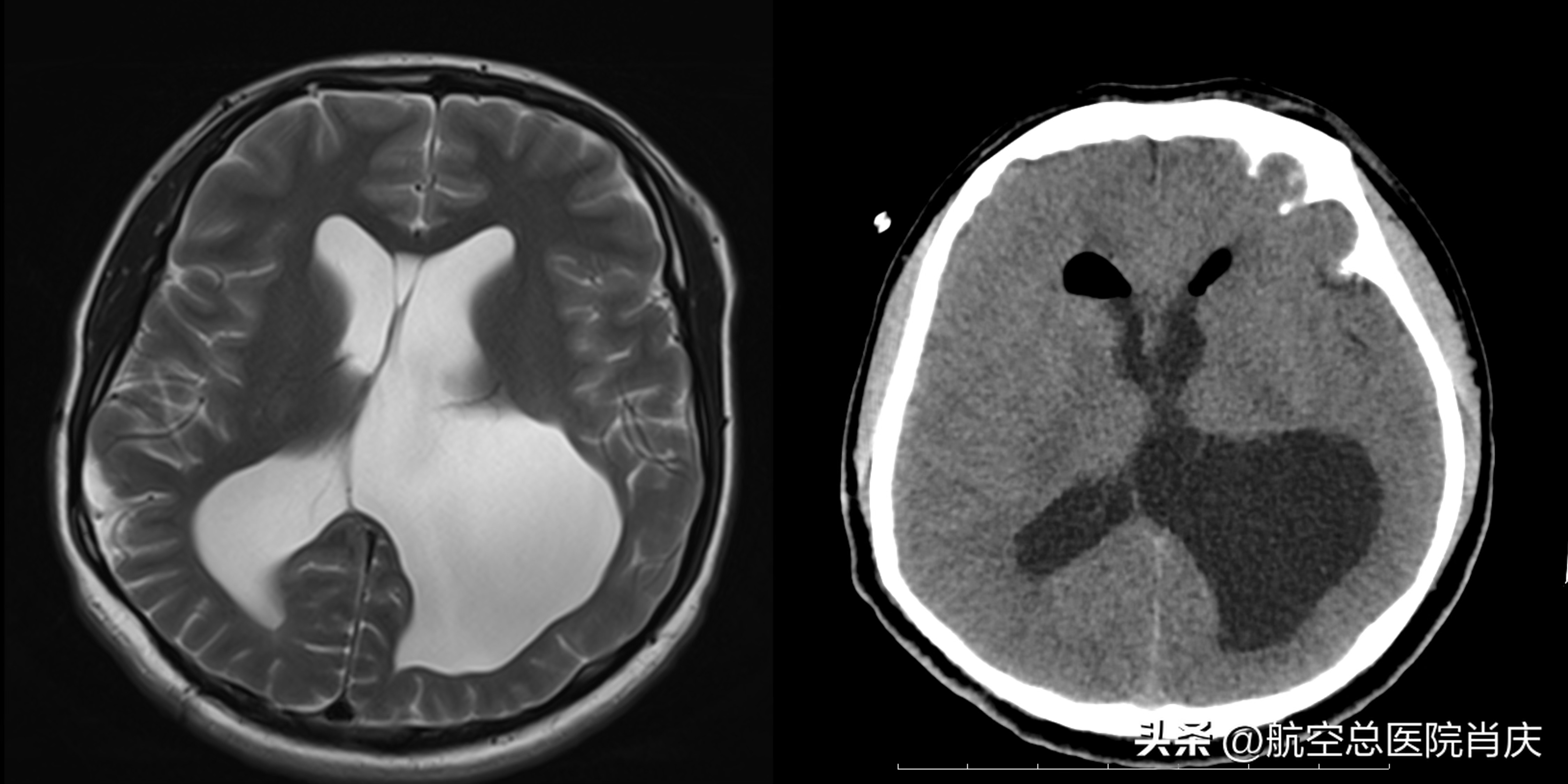 脑积水手术治疗方法最普遍,脑积水的微创治疗