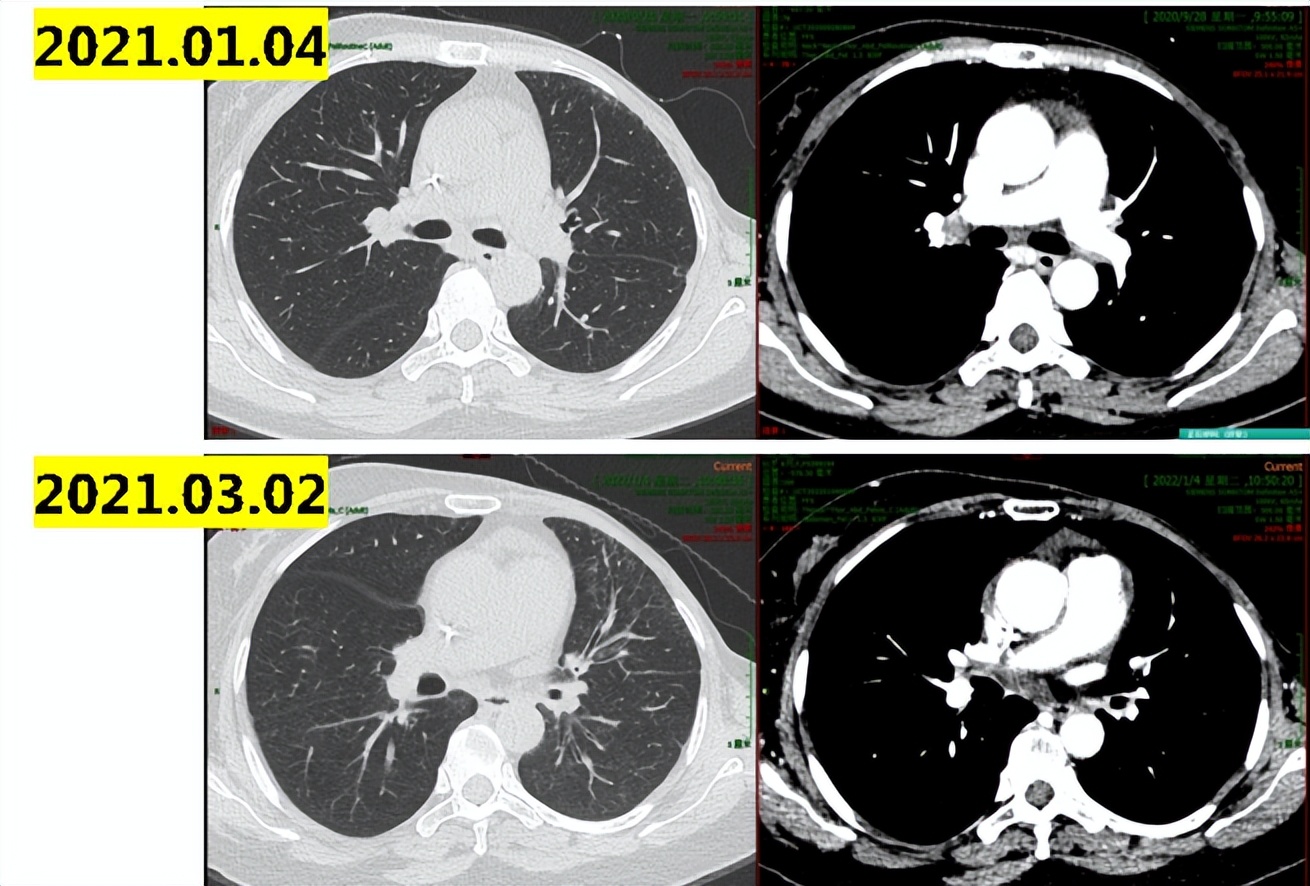 乳腺癌晚期没多少钱怎么治疗最佳,经济困难癌症晚期可以放弃治疗吗