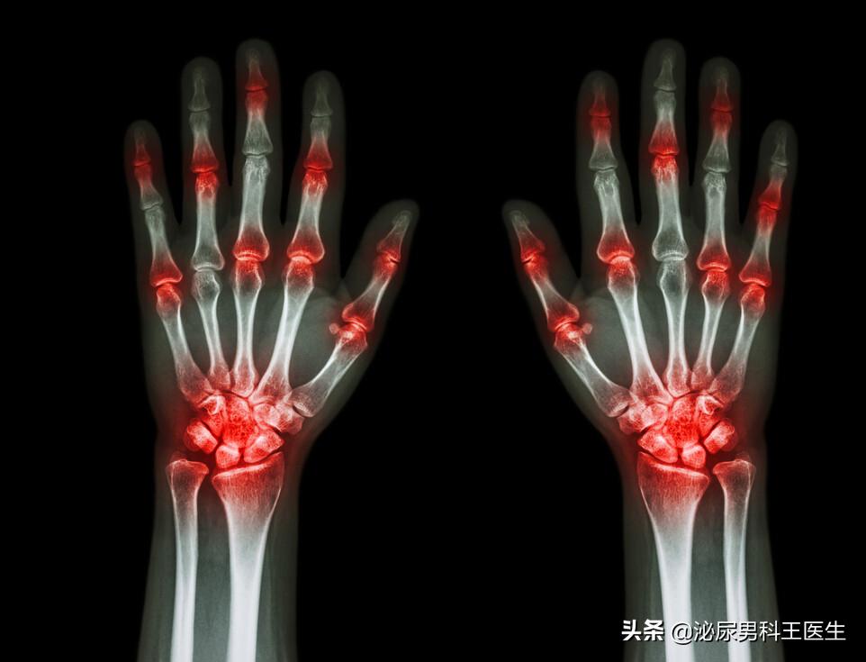 尿酸过高怎么能快速排出尿酸,尿酸高如何排出