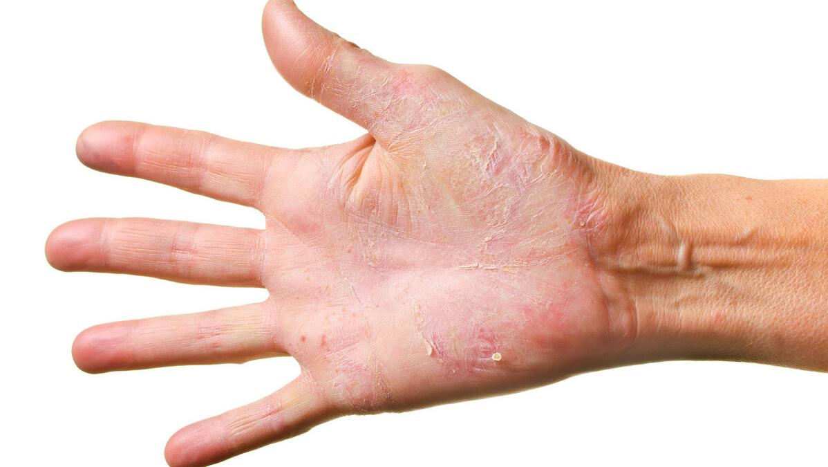 湿疹治愈期特别痒用什么药,湿疹很痒怎么处理用什么药