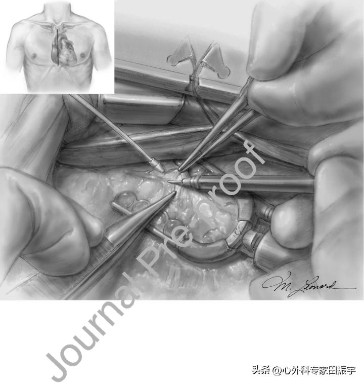 心肌桥松解术风险,去顶减压术是什么意思