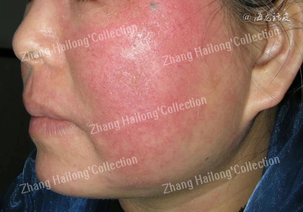 大红脸敏感皮肤,敏感肌肤大红脸怎么办