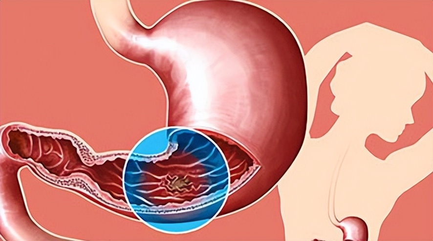 复方甘草片止咳神药,止咳药片甘草片能长期服用吗