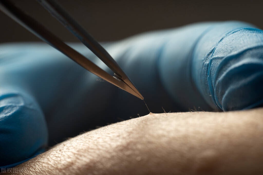 阴毛有啥作用?可以刮掉吗?从黑变白代表不健康?女性别羞于了解