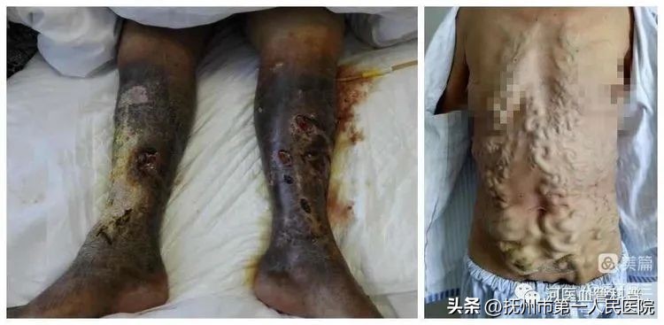 布加氏综合征介入治疗的注意事项,布加综合征介入手术加支架的利弊