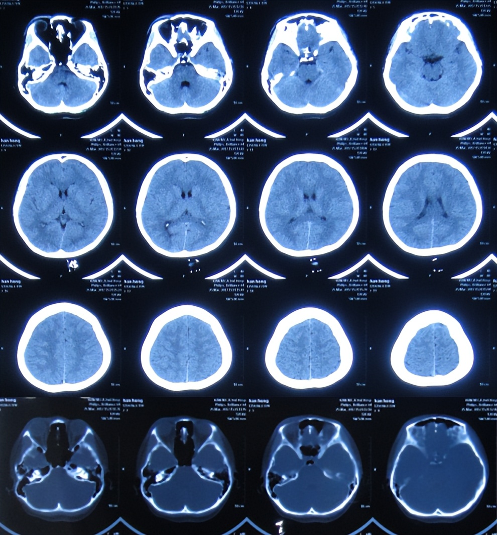 结核脑炎型脑积水怎么治,结核性脑膜炎2期很严重吗