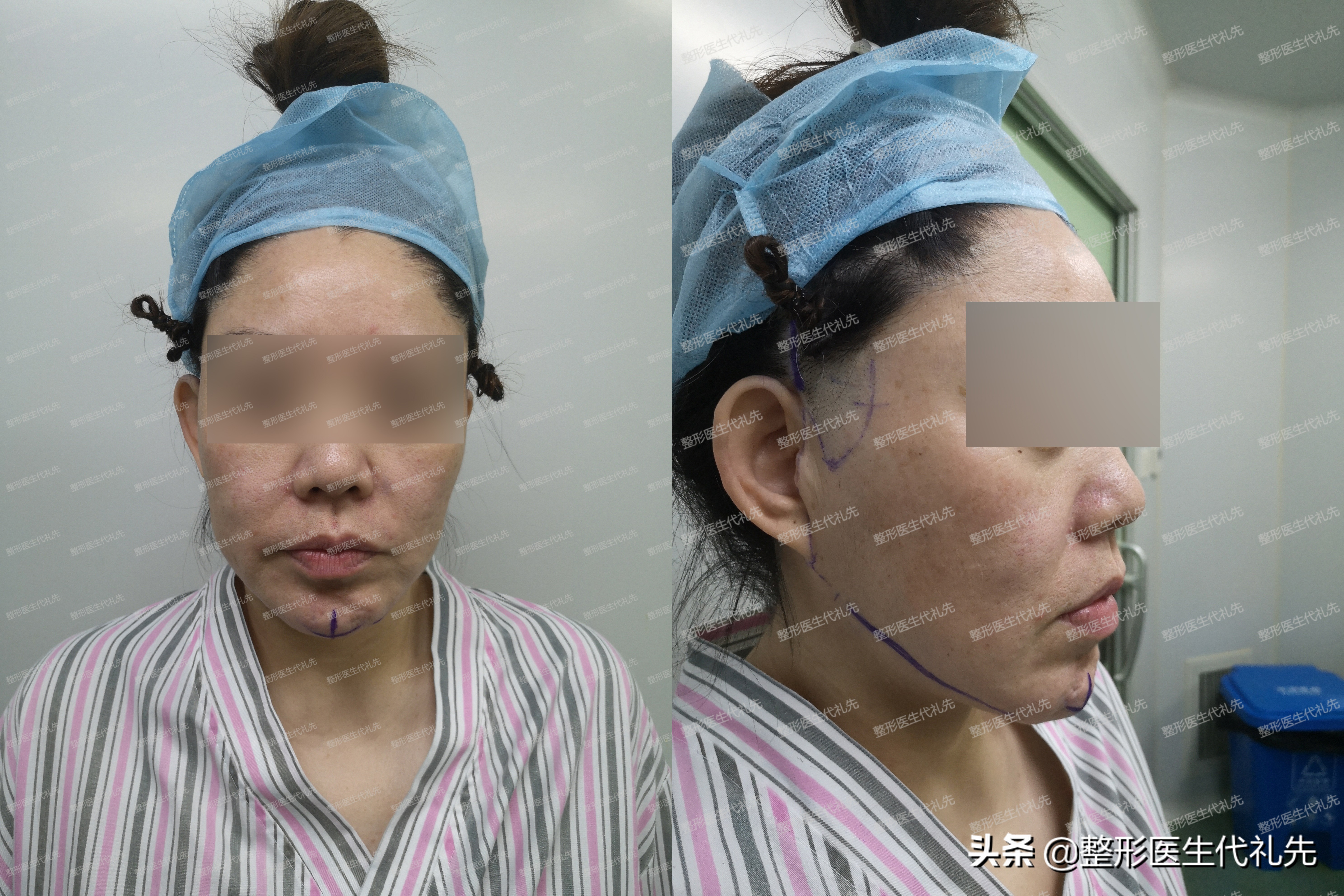 有法令纹最好的解决办法真实有效,法令纹严重最有效的办法