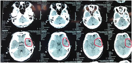 十四岁发生癫痫发作怎么回事,少年突发癫痫