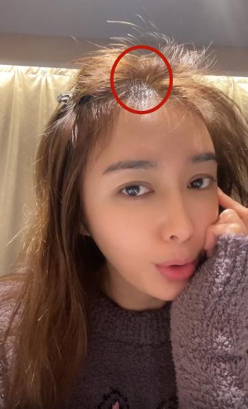 盘点女明星发际线危机,女明星秃头前后对比